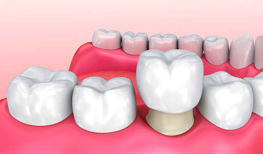 Benefits and Risks of Dental Crowns